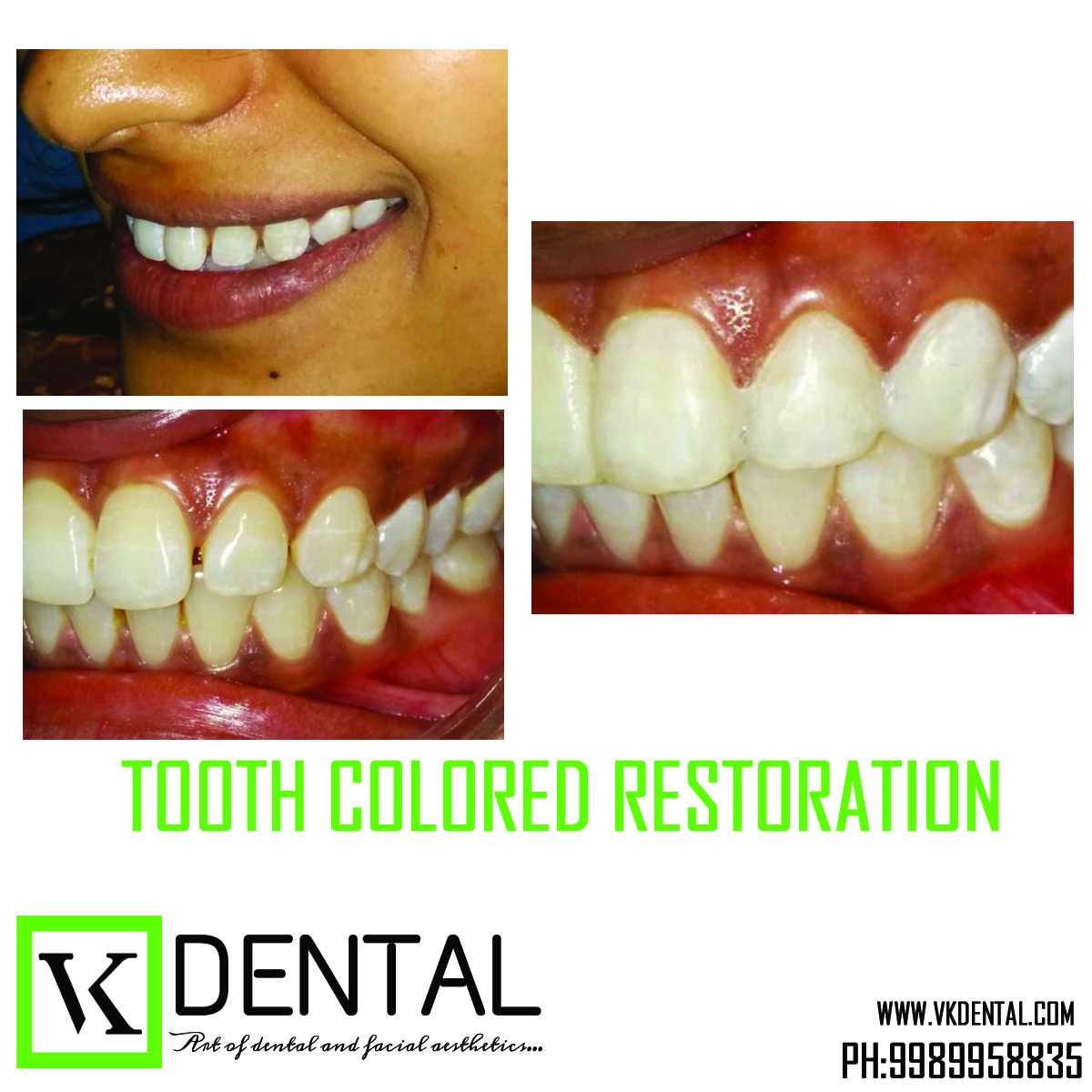 SMILE CORRECTION/DESIGNING